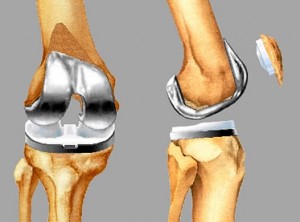 knee replacement knee replacement